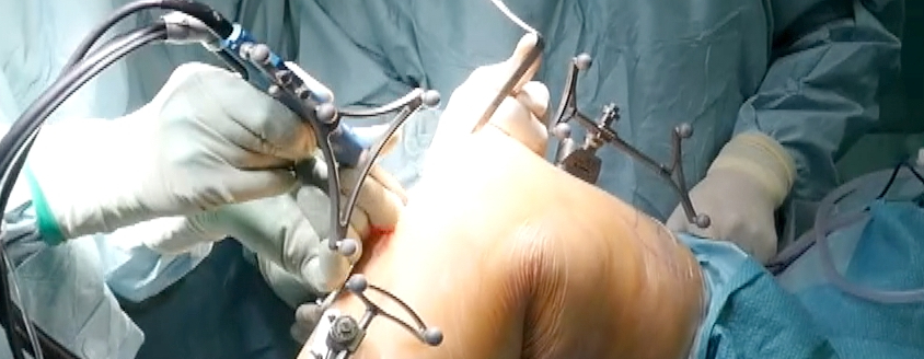 esempio di chirurgia protesica in sala operatoria