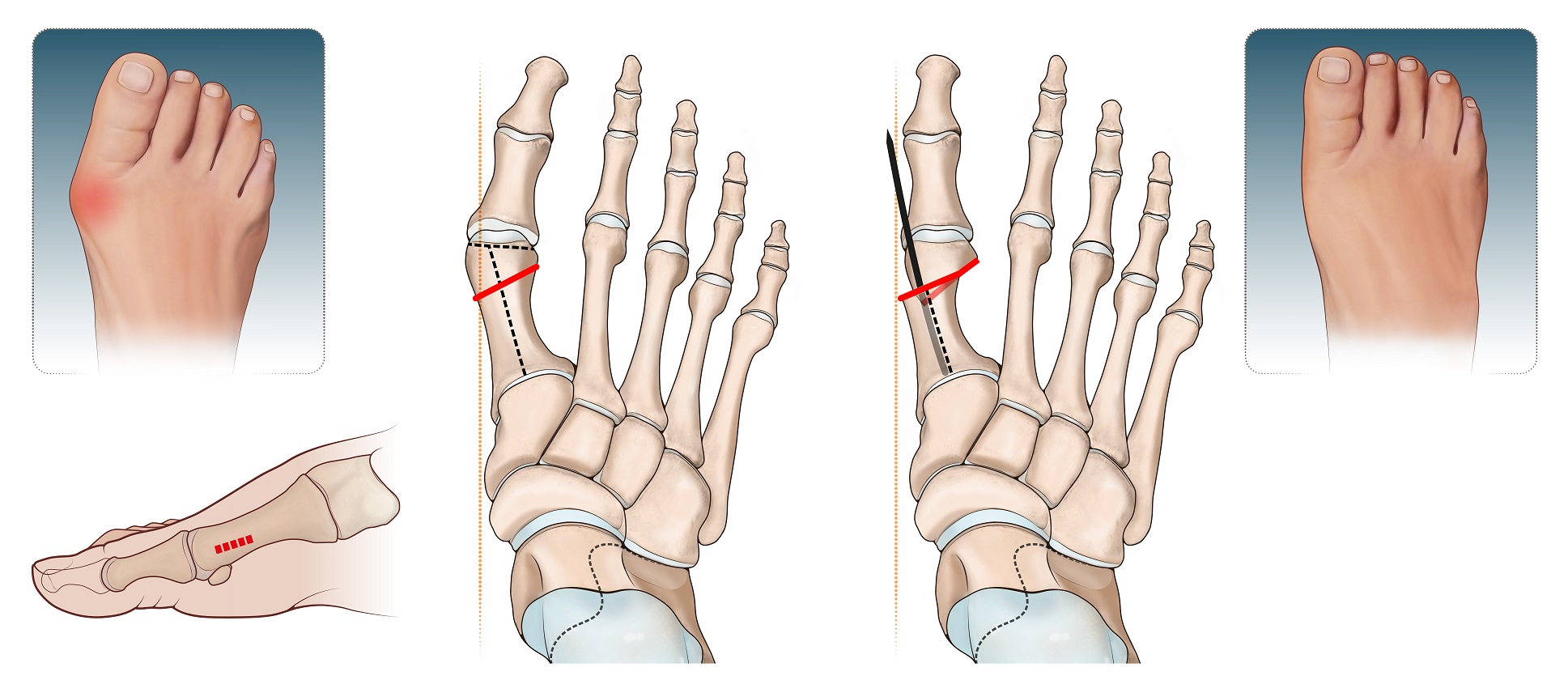 Rappresentazione del trattamento chirurgico dell'alluce valgo