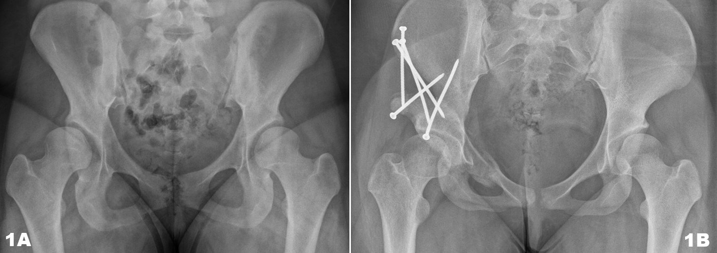 Fig. 1 (A e B): Paziente affetta da displasia acetabolare con sfuggenza del tetto acetabolare e insufficiente copertura acetabolare anteriore  operata di PAO per aumentare la stabilità e la congruenza della testa del femore con l’acetabolo.