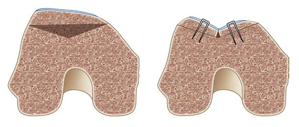 Fig. 4 - Trocleoplastica