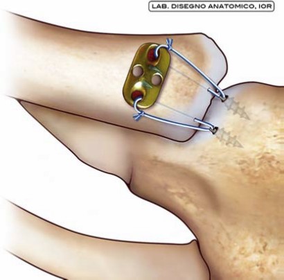 Fig. 4 - Sublussazione dell’articolazione sterno-claveare: ricostruzione dell’articolazione
