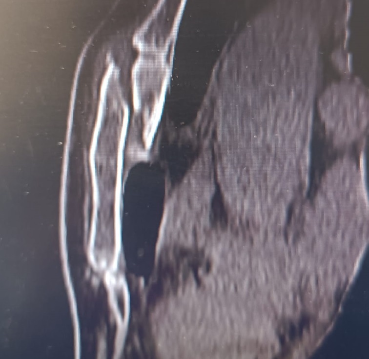 Tomografia Computerizzata del Torace: ricostruzione sagittale che mostra una frattura scomposta dello sterno con monconi sovrapposti