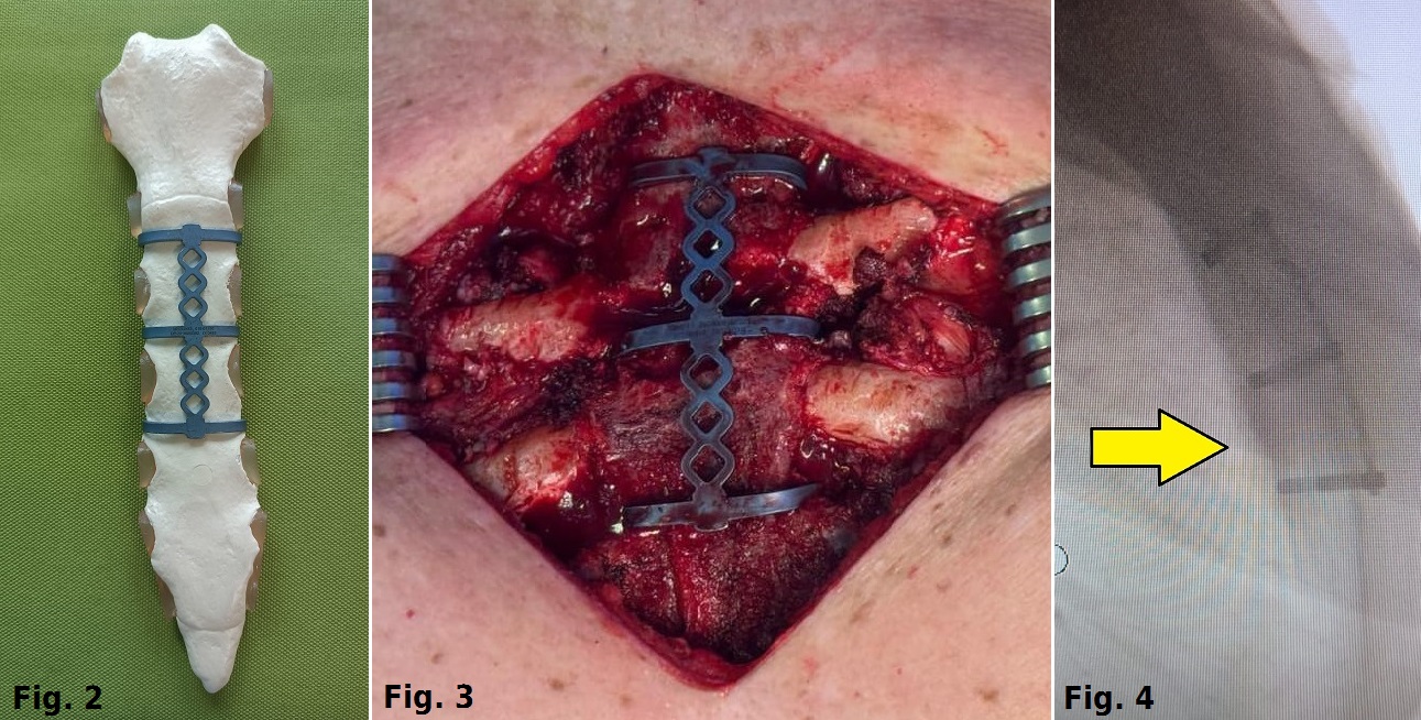 Figure 2, 3 e 4: stabilizzazione dello sterno con placche e viti