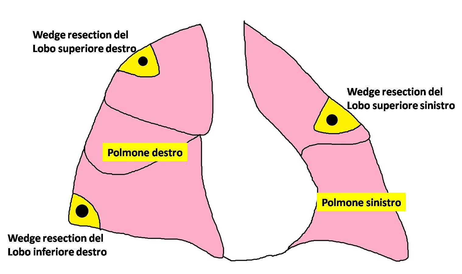 Rappresentazione schematica di tre tipi di metastasectomie polmonari realizzate con intervento chirurgico di wedge resection polmonare a carico del lobo superiore destro, inferiore destro e superiore sinistro