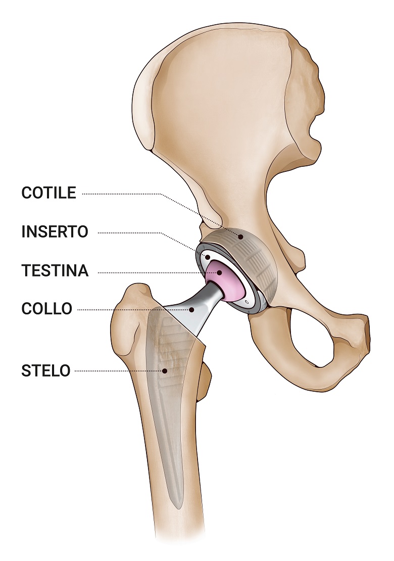 Cosa aspettarsi dopo l’intervento La protesi d’anca migliora sensibilmente il dolore e la funzionalità. La maggior parte dei pazienti può tornare a svolgere attività quotidiane e lavorative leggere dopo poche settimane. Le attività consigliate includono: •	Camminate; •	Nuoto; •	Ciclismo; •	Ginnastica dolce. Sono invece sconsigliati sport ad alto impatto (es. corsa veloce, calcio, rugby, basket con contatto, paracadutismo e altri sport estremi), che aumentano il rischio di usura precoce o dislocazione della protesi. Controlli e prevenzione a lungo termine •	Controlli ortopedici periodici con radiografie, inizialmente mensili e successivamente annuali; •	Prevenzione delle infezioni (informare dentisti e medici della presenza della protesi); •	Attenzione alle cadute, soprattutto nei primi mesi. Una corretta gestione post-operatoria e il rispetto delle indicazioni di comportamento sono fondamentali per il successo dell’intervento.