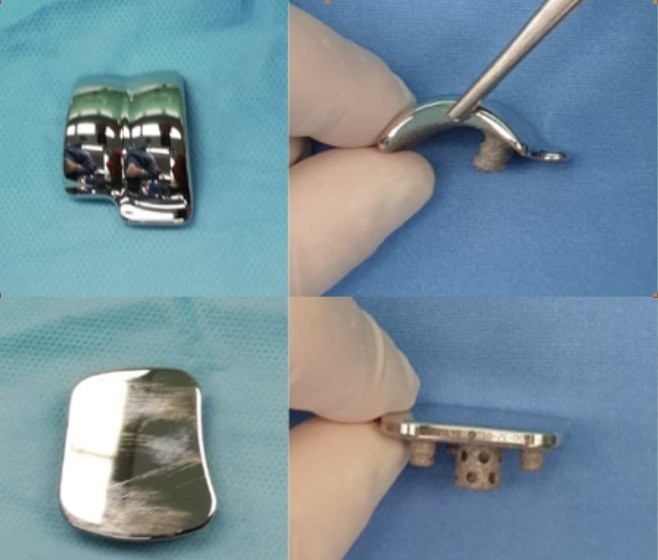 Protesi di caviglia a due componenti