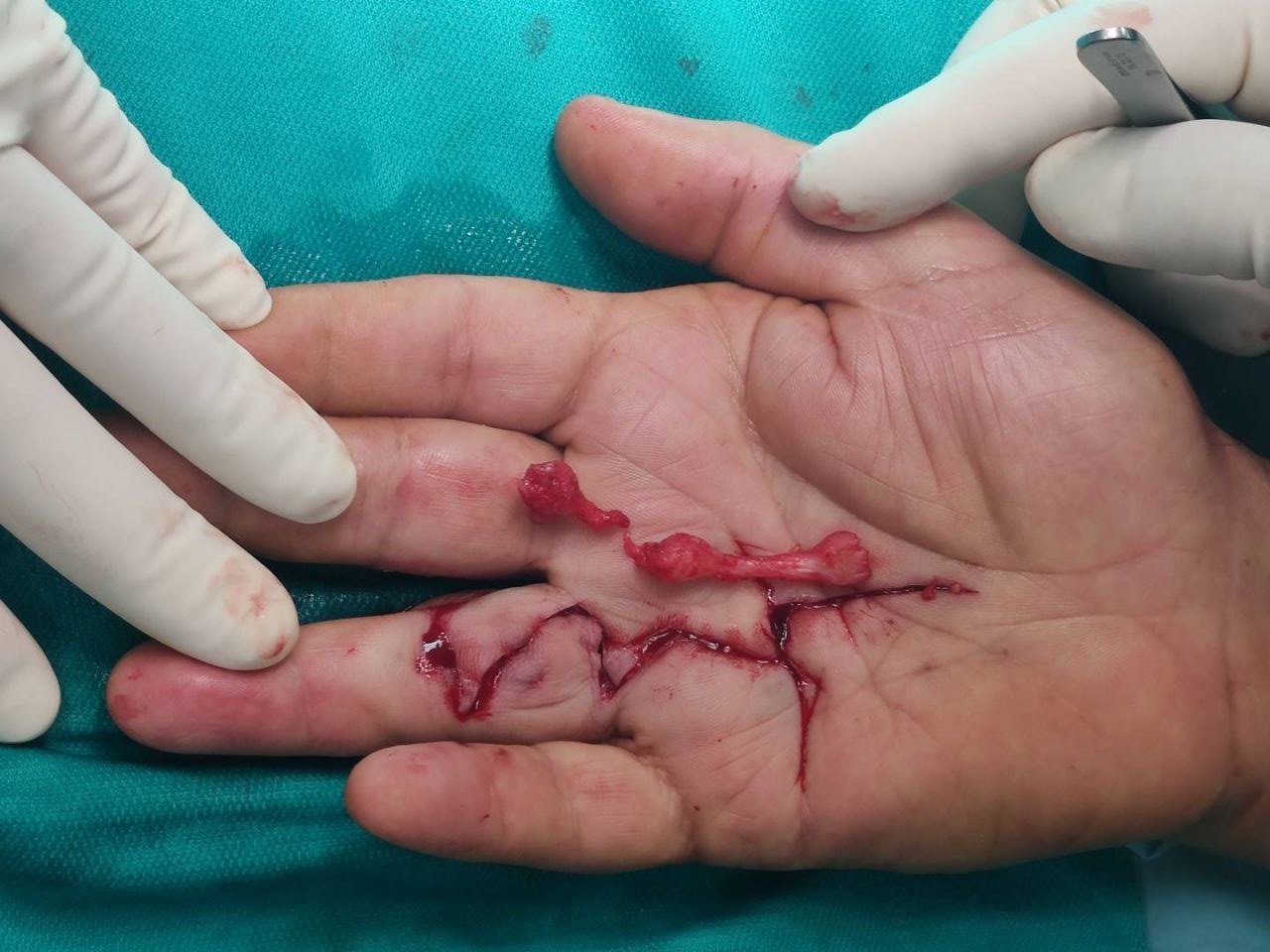 Fig. 3b. La stessa mano dopo l'intervento chirurgico di aponeurectomia