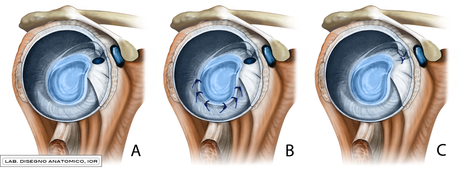 Fig. 2: Diagram showing the shoulder in case of normal anatomy (A), after arthroscopic capsuloplasty with capsulolabral plications from 3 to 9 hours later (B), and after vertical closure of the rotator interval also under arthroscopy (C).