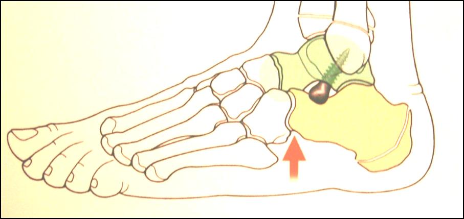 Fig. 5b: esempio di applicazione di vite Spherus per correzione del retropiede