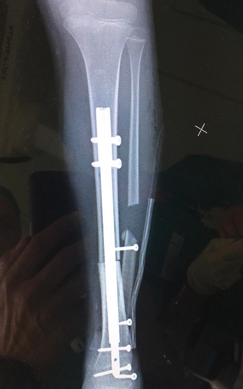 Post-intervention X-ray, with the visible extendable nail