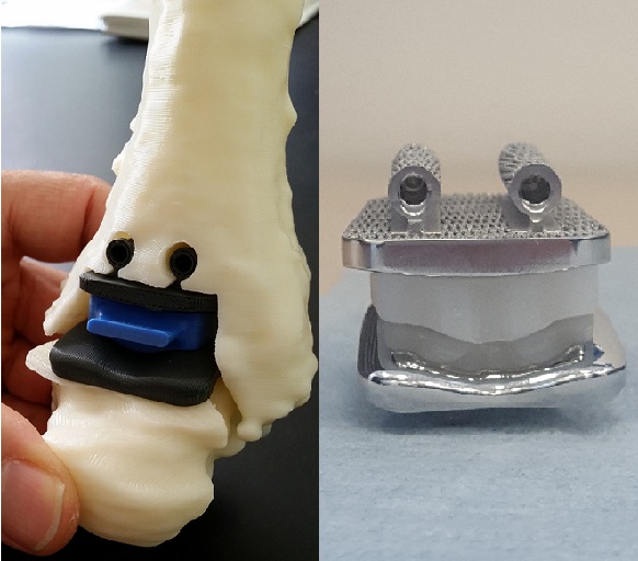 Una simulazione della protesi (a sinistra) e la protesi in lega.