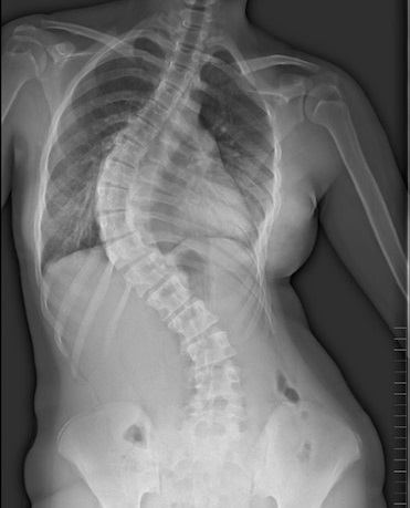 Radiografia di una scoliosi idiopatica