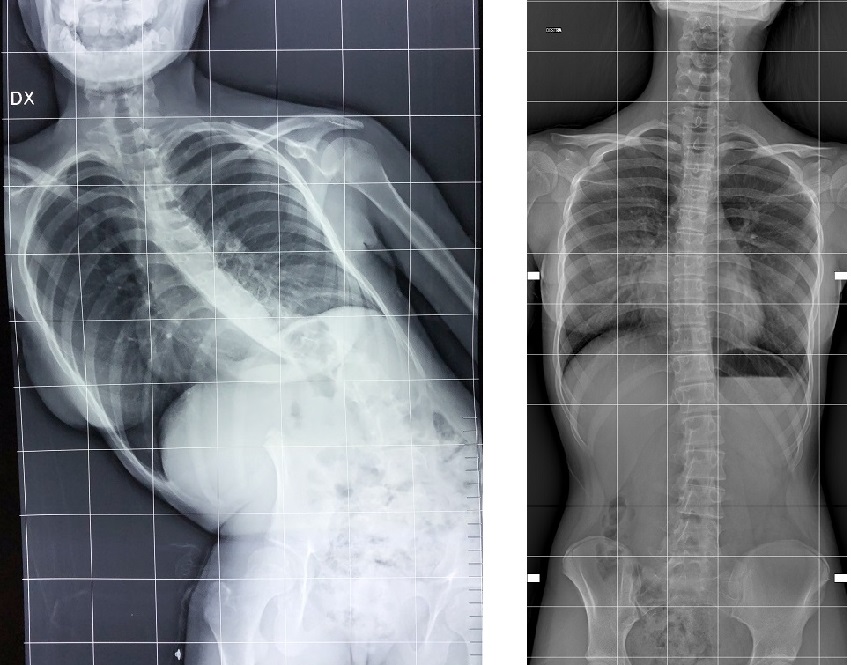 Immagine radiografica della paziente pre- e post-intervento